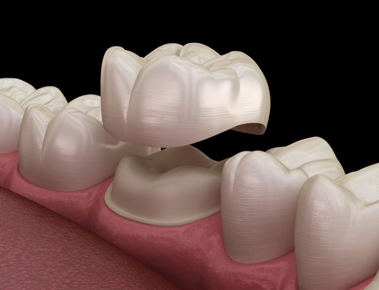dental crown 2