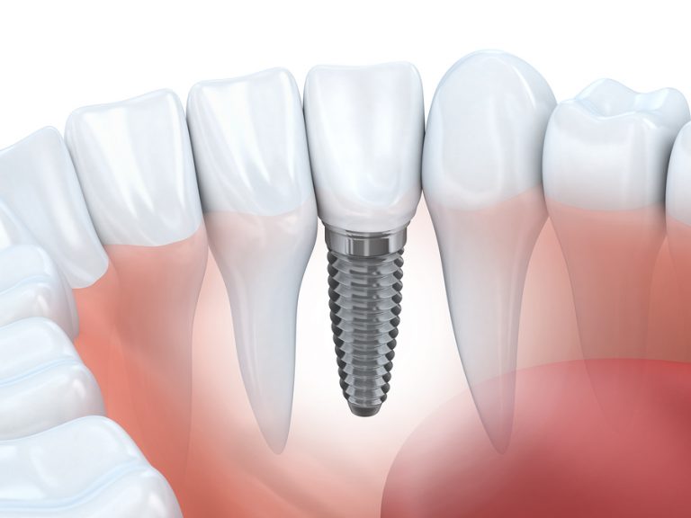 Implant Restorations in hillsborough nj