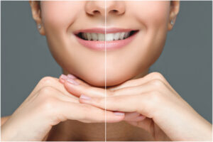 the science behind teeth whitening